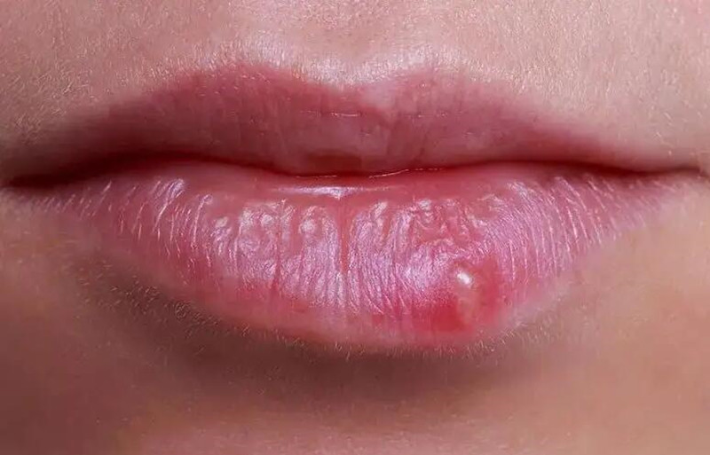 紋唇后起泡怎么辦？南寧紋唇培訓(xùn)學(xué)校教你方法
